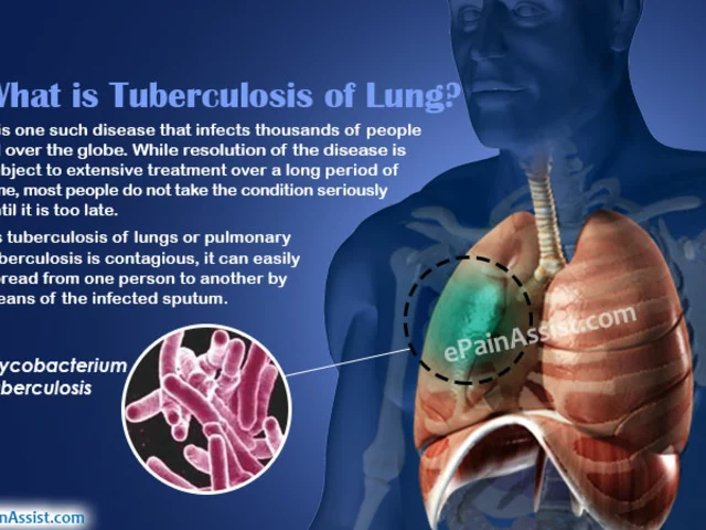 How to Prevent the Spread of Tuberculosis
